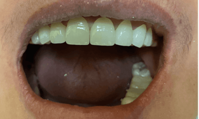 Veneers-for-Spacing-Discoloration-After-Image
